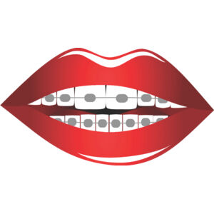 Lips Braces 2 Thumbnail