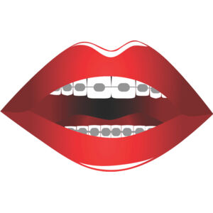 Lips Braces 1 Thumbnail